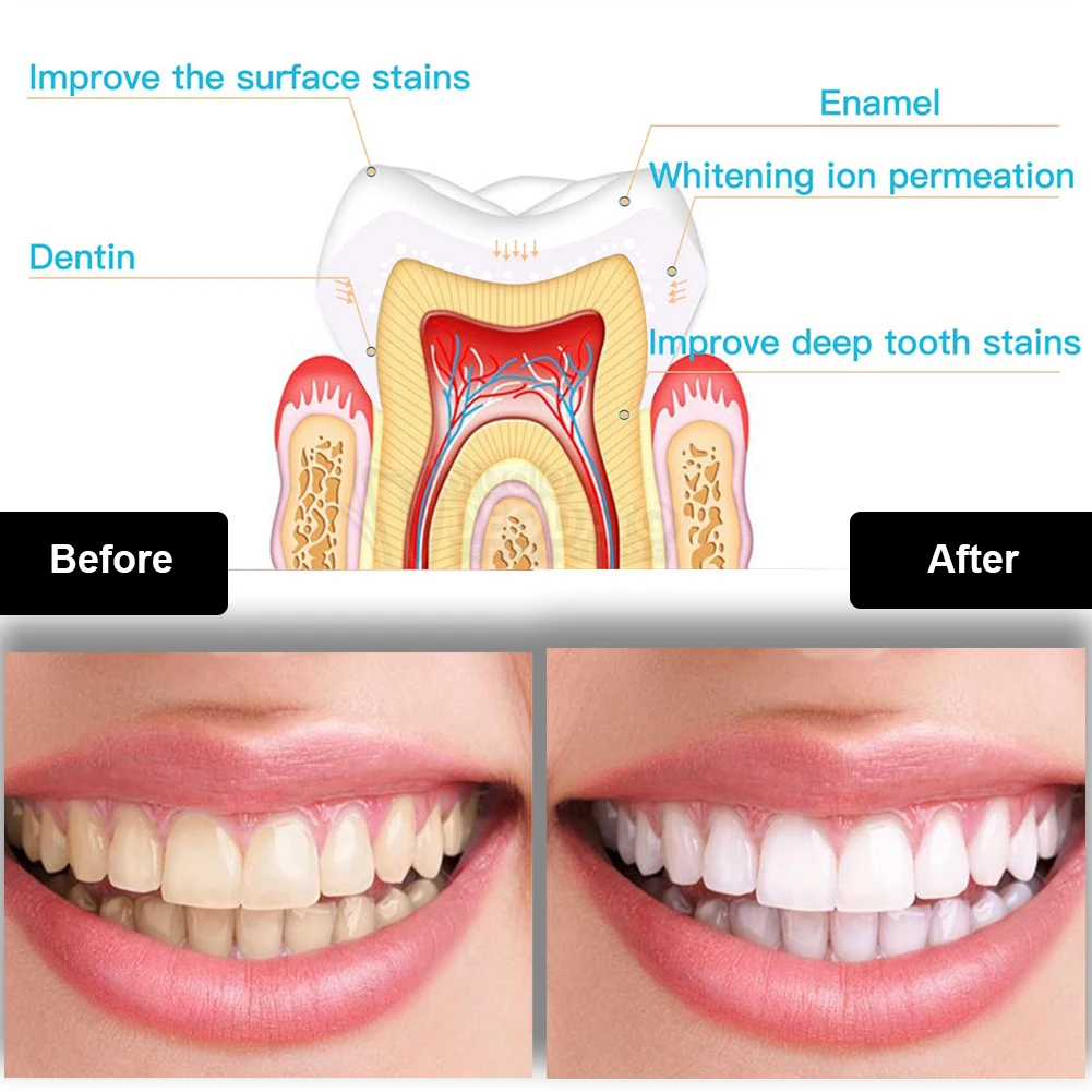 Kit de blanqueamiento Dental M - Teeth Whitening Led Kit reseña y precio